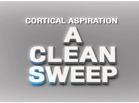 Cataract - Cortical Aspiration: A Clean Sweep