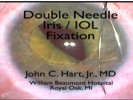 Cataract - Double-Needle Iris/IOL Fixation