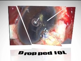 Cataracte - Lentille intraoculaire déposée
