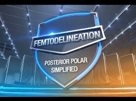 Cataracte - Femto-délimitation : pôle postérieur simplifié