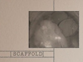 Cataracte - Implant intraoculaire de Scaffold Cataracte - Implant intraoculaire de Scaffold