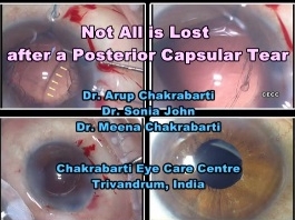 Cataracte - Tout n'est pas perdu après une déchirure capsulaire postérieure