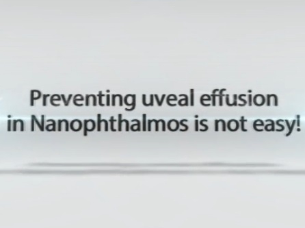 Cataract - Preventing Uveal Effusion in Nanophthalmos Is Not Easy!
