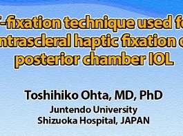 Cataracte - Technique de T-fixation utilisée pour la fixation de la lentille haptique intrascléral dans la chambre postérieure intra-oculaire Cataracte - Technique de T-fixation utilisée pour la fixation de la lentille haptique intrascléral dans la chambre postérieure intra-oculaire