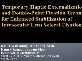 Cataracte - Externalisation haptique temporaire et double-points de fixation pour améliorer la stabilisation d'une fixation sclérale de lentille intra-oculaire Cataracte - Externalisation haptique temporaire et double-points de fixation pour améliorer la stabilisation d'une fixation sclérale de lentille intra-oculaire