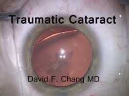 Cataracte - Cataracte traumatique : Gestion du prolapsus du corps vitreux Cataracte - Cataracte traumatique : Gestion du prolapsus du corps vitreux