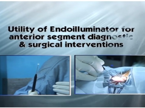 Cataract - Utility of Endoilluminator for Anterior Segment Diagnostic and Surgical Interventions Cataract - Utility of Endoilluminator for Anterior Segment Diagnostic and Surgical Interventions