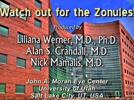 Cataracte - Attention aux zonules!
