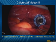 Caudal to Cranial Approach plus D3 Lymph Node Dissection around the Superior Mesenteric Artery Caudal to Cranial Approach plus D3 Lymph Node Dissection around the Superior Mesenteric Artery