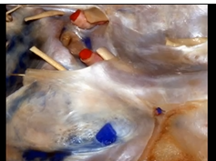 Cavernous Sinus and Middle Fossa (3D) - Part 1 of 2