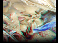 Cavernous Sinus and Middle Fossa (3D) - Part 2 of 2 Cavernous Sinus and Middle Fossa (3D) - Part 2 of 2