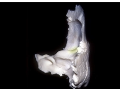 Cavernous Sinus and Middle Fossa (3D) - Part 2 of 2