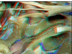 Cavernous Sinus and Middle Fossa - Part 1 of 2