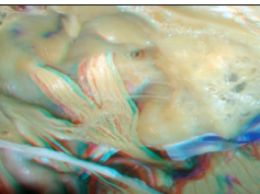 Cavernous Sinus and Middle Fossa - Part 2 of 2