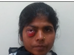 Cavernous Sinus Thrombosis Cavernous Sinus Thrombosis