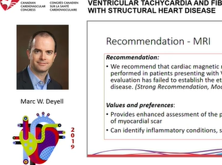 CCC 2019: CCS/CHRS POSITION STATEMENT ON THE MANAGEMENT OF VENTRICULAR TACHYCARDIA AND FIBRILLATION CCC 2019: CCS/CHRS POSITION STATEMENT ON THE MANAGEMENT OF VENTRICULAR TACHYCARDIA AND FIBRILLATION