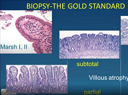 Celiac Disease: Novel Therapeutic Approaches Beyond Gluten Withdrawal