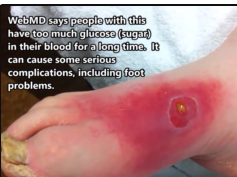 Cellulitis Foot? Plus RESTMORE Sleep Formula