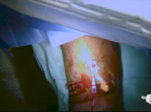 Central Vein Balloon Angioplasty Central Vein Balloon Angioplasty