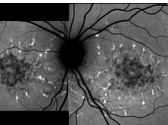 Centrifugal Expansion of Fundus Autofluorescence Patterns in Stargardt Disease Over Time Part 1 Centrifugal Expansion of Fundus Autofluorescence Patterns in Stargardt Disease Over Time Part 1