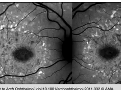 Centrifugal Expansion of Fundus Autofluorescence Patterns in Stargardt Disease Over Time Part 2 Centrifugal Expansion of Fundus Autofluorescence Patterns in Stargardt Disease Over Time Part 2