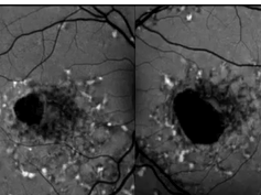 Centrifugal Expansion of Fundus Autofluorescence Patterns in Stargardt Disease Over Time Part 3 Centrifugal Expansion of Fundus Autofluorescence Patterns in Stargardt Disease Over Time Part 3
