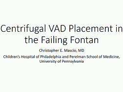 Centrifugal VAD Placement in the Failing Fontan