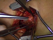 Cephalic Arch Reconstruction Cephalic Arch Reconstruction