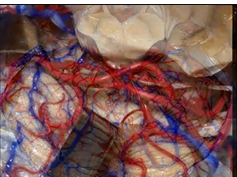 Cerebellopontine Angle and Fourth Ventricle (3D) - Part 1 of 2