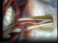Cerebellopontine Angle and Fourth Ventricle (3D) - Part 2 of 2 Cerebellopontine Angle and Fourth Ventricle (3D) - Part 2 of 2