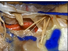 Cerebellopontine Angle and Fourth Ventricle (3D) - Part 2 of 2
