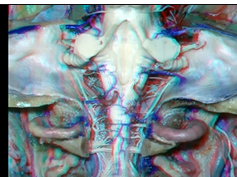 Cerebellopontine Angle and Fourth Ventricle - Part 1 of 2