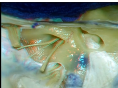 Cerebellopontine Angle and Fourth Ventricle - Part 2 of 2