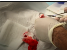 Chainsaw Accident! Lacerations, Cysts, Blackheads & Surgery!