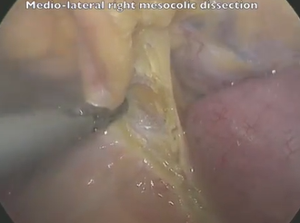 Challenging Emergency Laparoscopic Right Colectomy for Completely Obstructing Caecal Carcinoma Challenging Emergency Laparoscopic Right Colectomy for Completely Obstructing Caecal Carcinoma