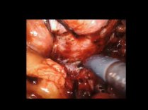 Challenging Scenarios During Bladder Neck Dissection