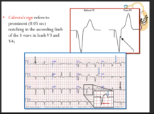 Chapman vs cabrera vs simplified sgarboss sign on ecg