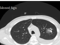 Chest -- CT scan Monod sign Chest -- CT scan Monod sign