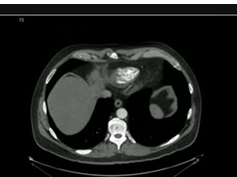 Chest, Pulmonary Embolism Chest, Pulmonary Embolism