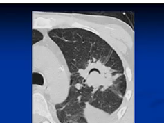Chest x-ray --Air Crescent Sign Chest x-ray --Air Crescent Sign