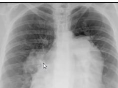 Chest x-ray --Anatomy of pulmonary arteries Chest x-ray --Anatomy of pulmonary arteries