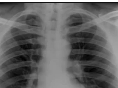 chest x-ray, artificial aortic and mitral valves chest x-ray, artificial aortic and mitral valves