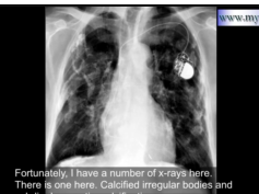 Chest x-ray - Asbestosis - Pleural calcifications - Round atelectasis Chest x-ray - Asbestosis - Pleural calcifications - Round atelectasis