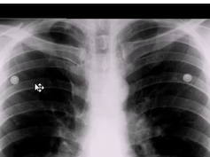 Chest x-ray, Azygos Lobe Chest x-ray, Azygos Lobe