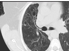 Chest x-ray --Bronchiectasis on CT and Chest x-ray Chest x-ray --Bronchiectasis on CT and Chest x-ray