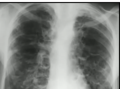 chest x-ray, bronchiectasis chest x-ray, bronchiectasis