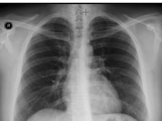 Chest x-ray -Cardiothoracic Ratio -CARDIAC SIZE - Cardiomegaly Chest x-ray -Cardiothoracic Ratio -CARDIAC SIZE - Cardiomegaly