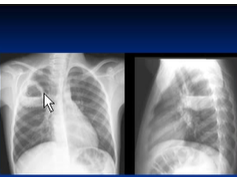 Chest x-ray --cavitating lesions Chest x-ray --cavitating lesions