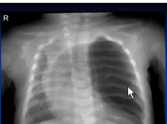 Chest x-ray, Congenital lobar emphysema Chest x-ray, Congenital lobar emphysema