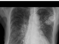 Chest x-ray -- Difference between Kerley B lines and blood vessels Chest x-ray -- Difference between Kerley B lines and blood vessels